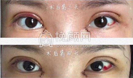 武汉同济周光瑜全切双眼皮+内眼角