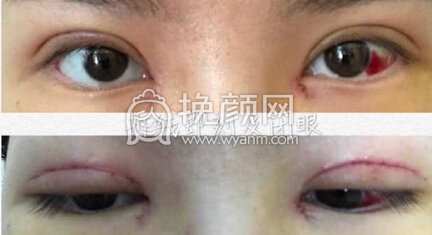 武汉同济周光瑜全切双眼皮+内眼角