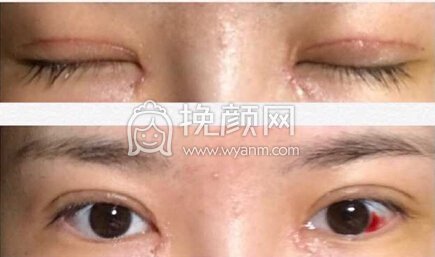 武汉同济周光瑜全切双眼皮+内眼角