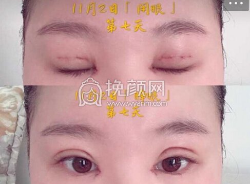 福建医大附属协和医院周亚宽双眼皮+开眼角+去皮