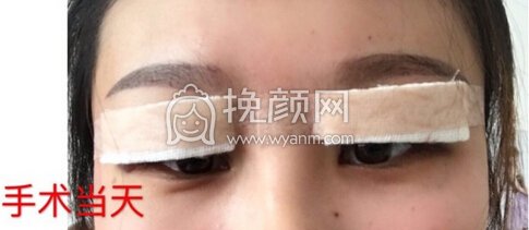 徐州三院熊主任去皮去脂小切口微创双眼皮