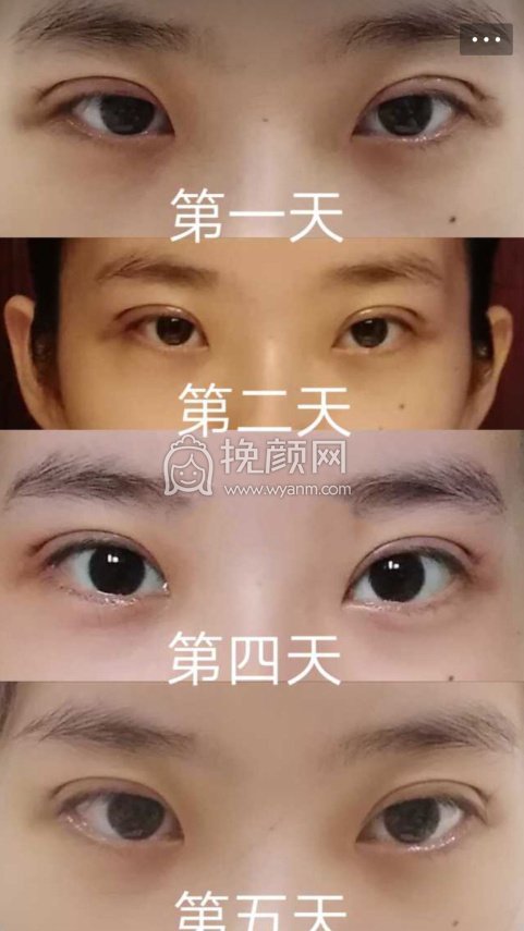 9.21号割的全切双眼皮去皮去脂肪四千多一点