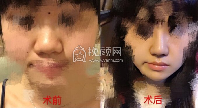 深圳美立达医院李信锋医生做的鼻部手术