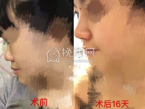 深圳美立达医院李信锋医生做的鼻部手术