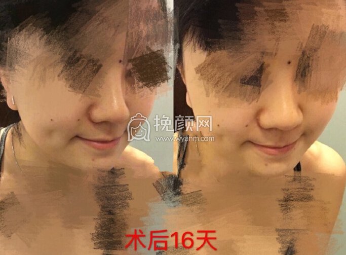 深圳美立达医院李信锋医生做的鼻部手术