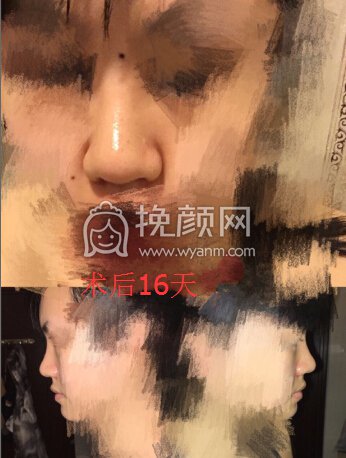 深圳美立达医院李信锋医生做的鼻部手术