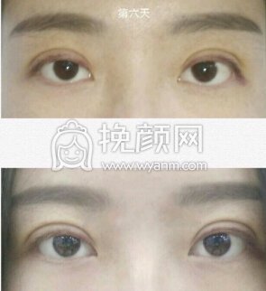 石家庄省二院张卓男张医生全切去皮去脂
