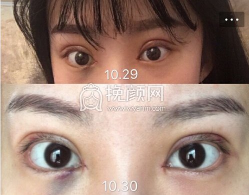 合肥市恒美医院廖院长做的眼部手术