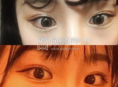 合肥市恒美医院廖院长做的眼部手术