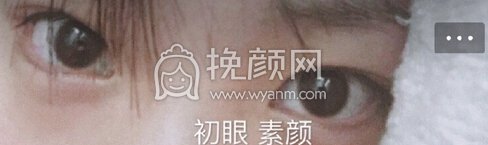合肥市恒美医院廖院长做的眼部手术