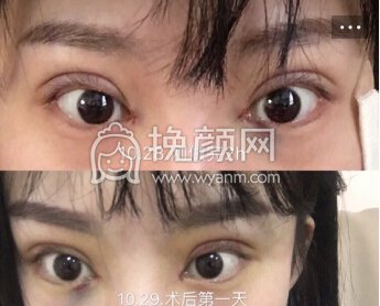 合肥市恒美医院廖院长做的眼部手术