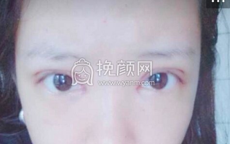 成都良好美妍徐彬医生做的去皮去脂提肌开眼角