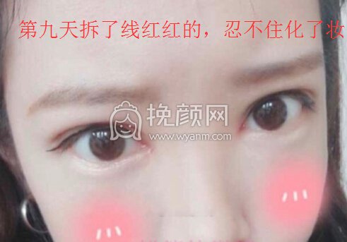 成都良好美妍徐彬医生做的去皮去脂提肌开眼角