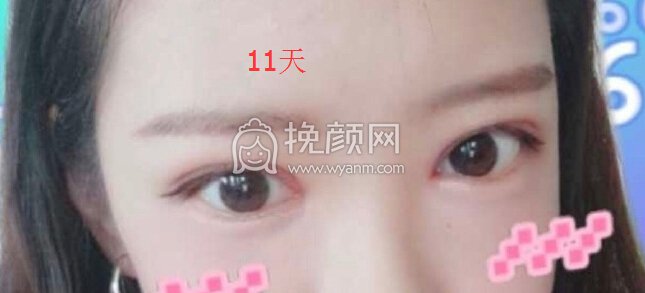 成都良好美妍徐彬医生做的去皮去脂提肌开眼角