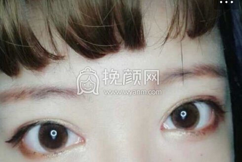 成都良好美妍徐彬医生做的去皮去脂提肌开眼角