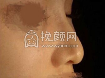 苏州薇琳医美院长曹芳假体、耳软骨取出鼻部手术
