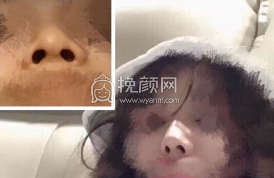 苏州薇琳医美院长曹芳假体、耳软骨取出鼻部手术