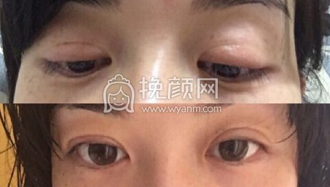 我是否需要做修复?大概需要多少钱?