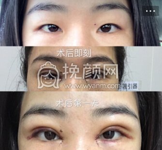 中山市如花整形美容门诊霍旺佳眼部手术加开眼角