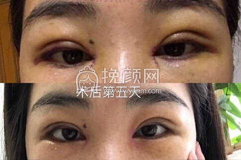 中山市如花整形美容门诊霍旺佳眼部手术加开眼角