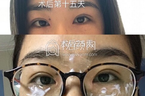 中山市如花整形美容门诊霍旺佳眼部手术加开眼角