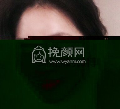 杭州树兰医院徐靖宏鼻部手术(硅胶假体+耳软骨)