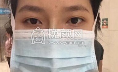 杭州树兰医院徐靖宏鼻部手术(硅胶假体+耳软骨)
