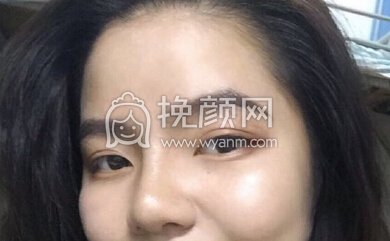 杭州树兰医院徐靖宏鼻部手术(硅胶假体+耳软骨)