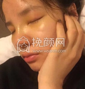 杭州树兰医院徐靖宏鼻部手术(硅胶假体+耳软骨)