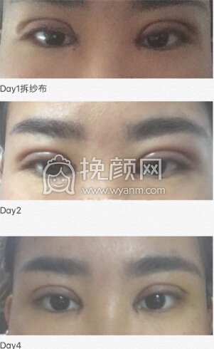 合肥华美赵辑院长双眼皮+开眼角