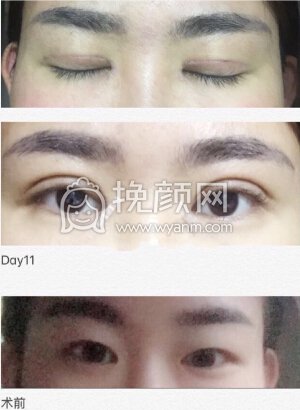 合肥华美赵辑院长双眼皮+开眼角