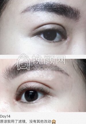 合肥华美赵辑院长双眼皮+开眼角