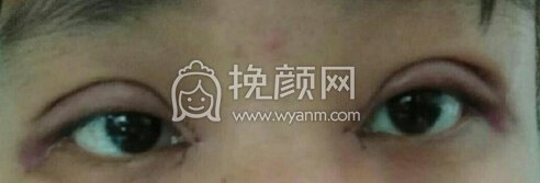 宁波珈禾费安军双眼皮+眼角+提肌+去皮去脂