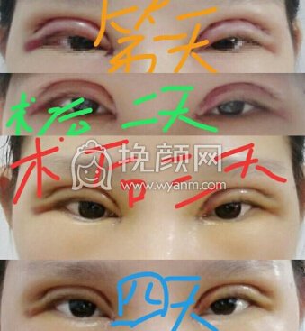 武汉美立方胡院长精切+开内眼角