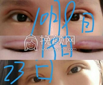 武汉美立方胡院长精切+开内眼角