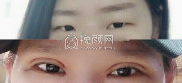 武汉美立方胡院长精切+开内眼角