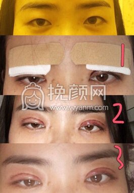 重庆康雅银山全切,上睑下垂矫正,双眼去皮去