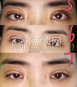 重庆康雅银山全切,上睑下垂矫正,双眼去皮去