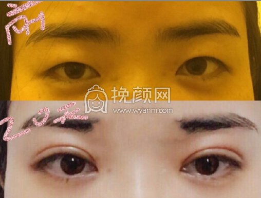 重庆康雅银山全切,上睑下垂矫正,双眼去皮去