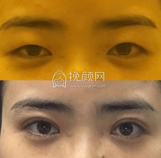 重庆康雅银山全切,上睑下垂矫正,双眼去皮去