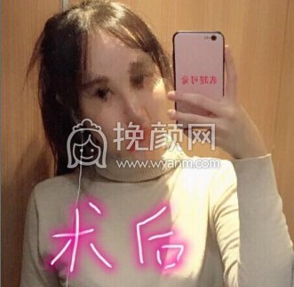 徐州丽珍医院张哲院长做的鼻部手术修复手术