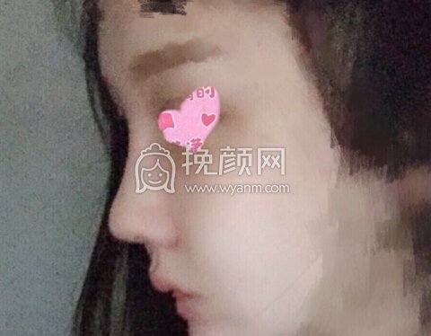 徐州丽珍医院张哲院长做的鼻部手术修复手术