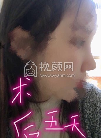 徐州丽珍医院张哲院长做的鼻部手术修复手术