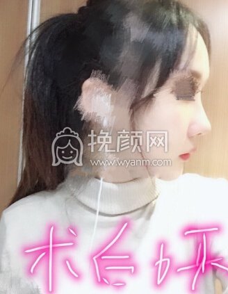 徐州丽珍医院张哲院长做的鼻部手术修复手术