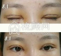 长沙美德思彭青和医生全切+开眼角