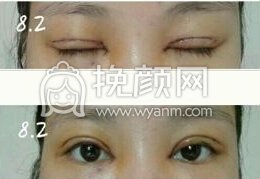 长沙美德思彭青和医生全切+开眼角