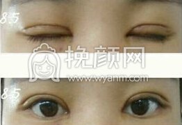 长沙美德思彭青和医生全切+开眼角