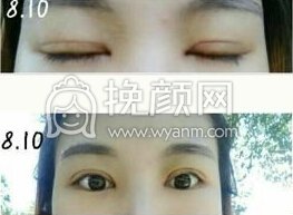 长沙美德思彭青和医生全切+开眼角