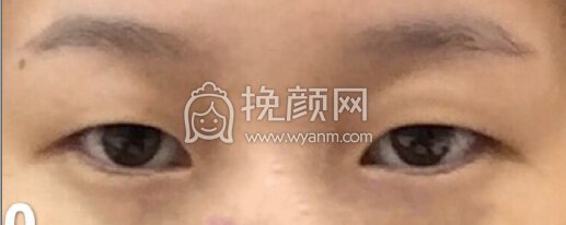 铜雀台徐敦小切口双眼皮+开眼角