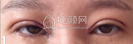 铜雀台徐敦小切口双眼皮+开眼角